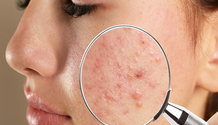 Acne