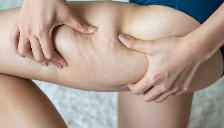Get Rid Of Cellulite
