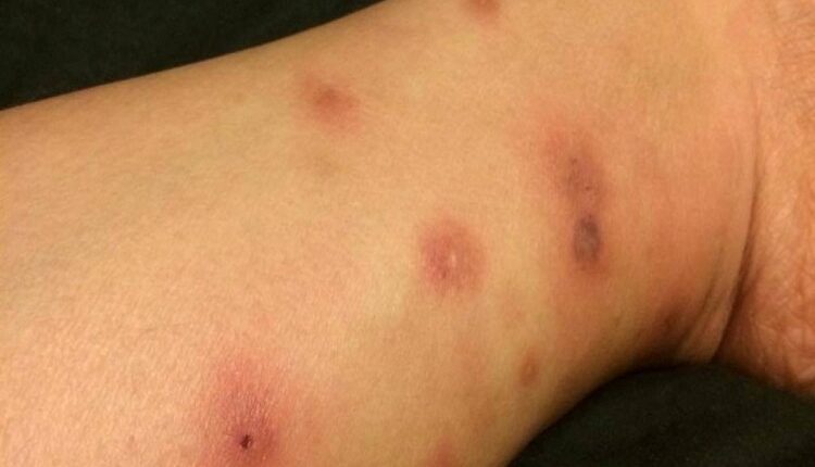 Bed Bugs Attack