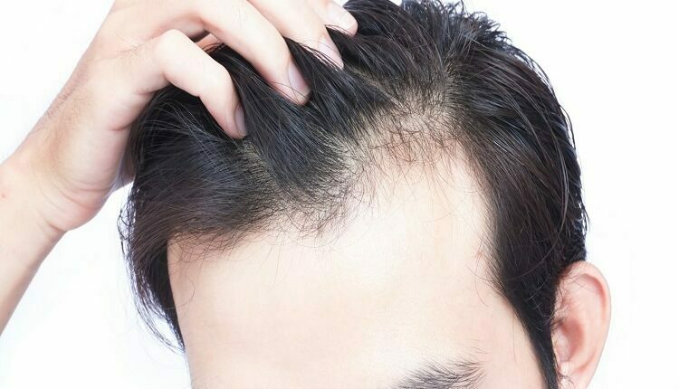 Hair Loss